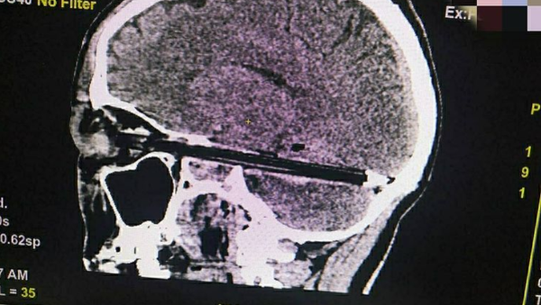 Ростовские врачи вытащили застрявшую в мозгу мужчины шариковую ручку