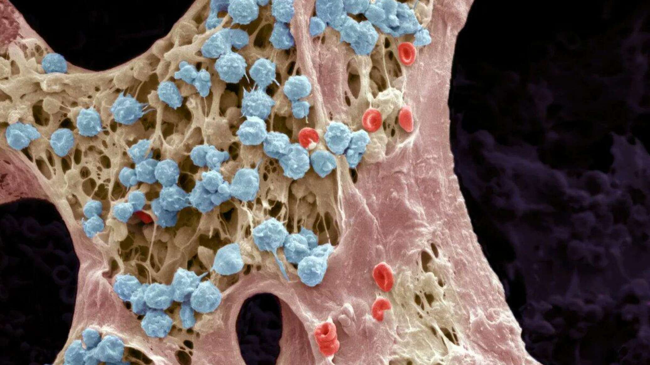Пораженный костный мозг. Стромальная клетка костного мозга. Стволовая клетка красного костного мозга. Стволовые клетки микрофотография. Гемопоэтические стволовые клетки под микроскопом.