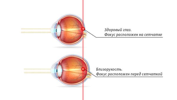 Удлиненное глазное яблоко вызывает близорукость Удлиненное глазное яблоко вызывает близорукость